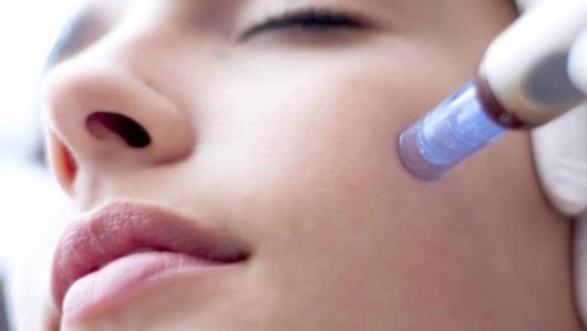 microneedling-1020x577-9